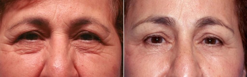 patient before and after brow lift