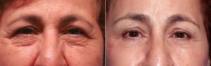 patient before and after brow lift