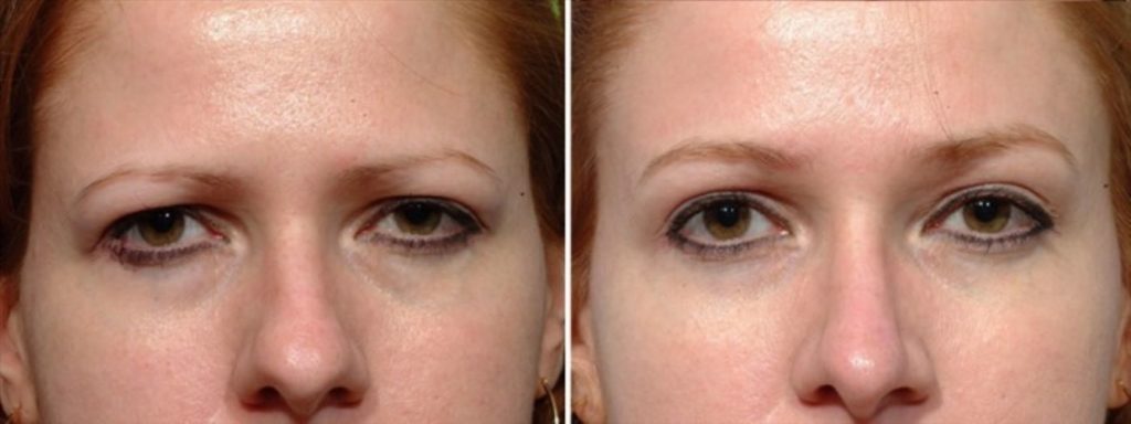 patient before and after brow lift