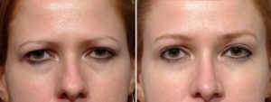patient before and after brow lift