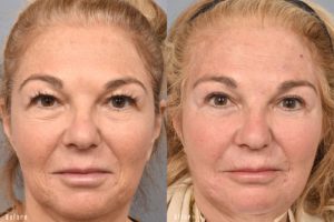 patient before and after brow lift