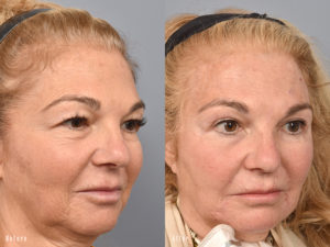 patient before and after brow lift