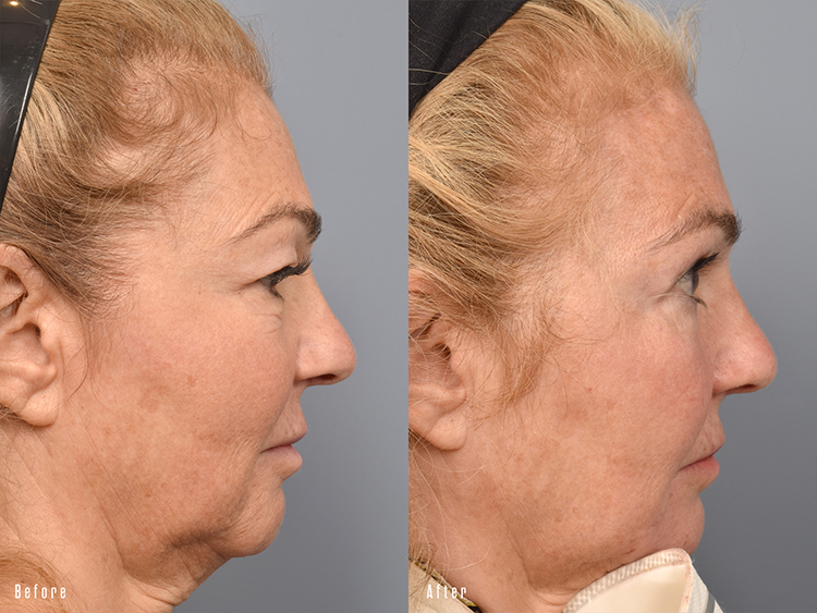 patient before and after brow lift