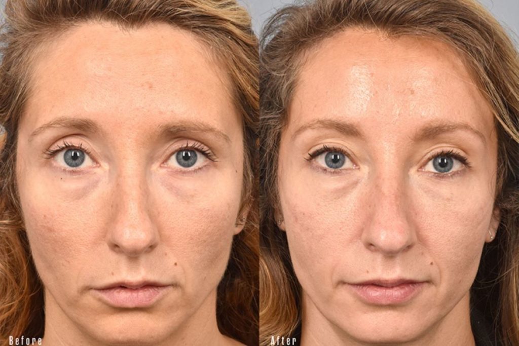 patient before and after brow lift