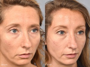 patient before and after brow lift