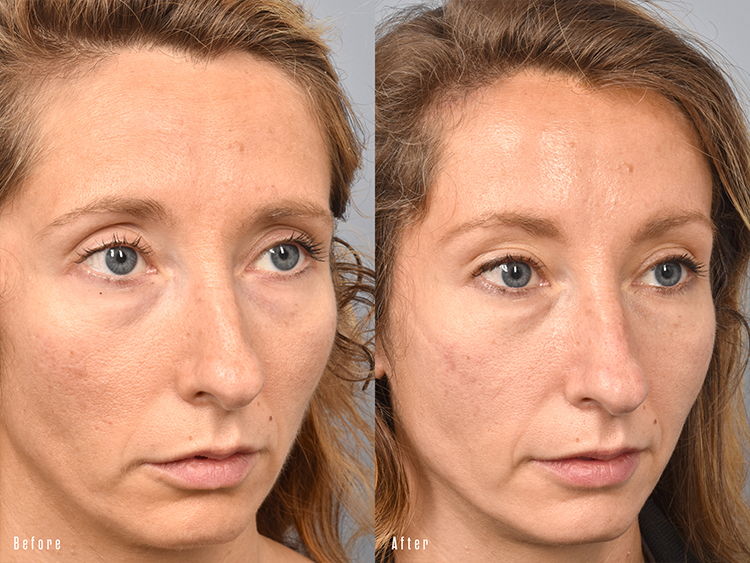 patient before and after brow lift