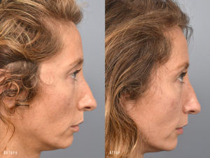 patient before and after brow lift