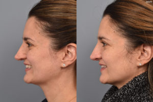 before and after revision rhinoplasty photos of female patient