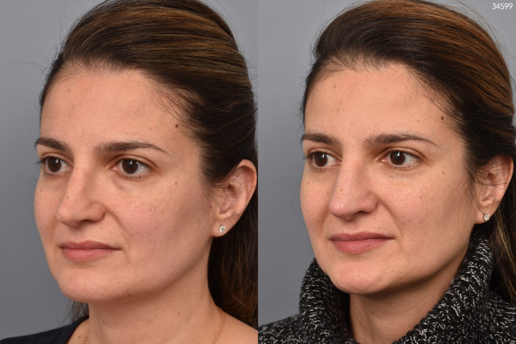 before and after revision rhinoplasty photos of female patient