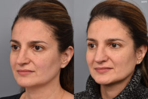 before and after revision rhinoplasty photos of female patient
