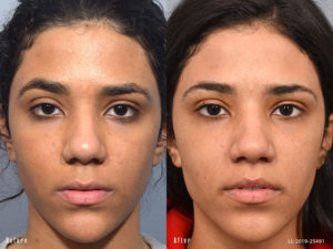 Female showing before and after results from a surgical lip lift