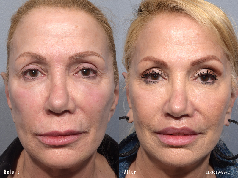 Female showing before and after results from a surgical lip lift