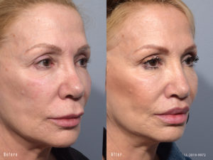 Female showing before and after results from a surgical lip lift