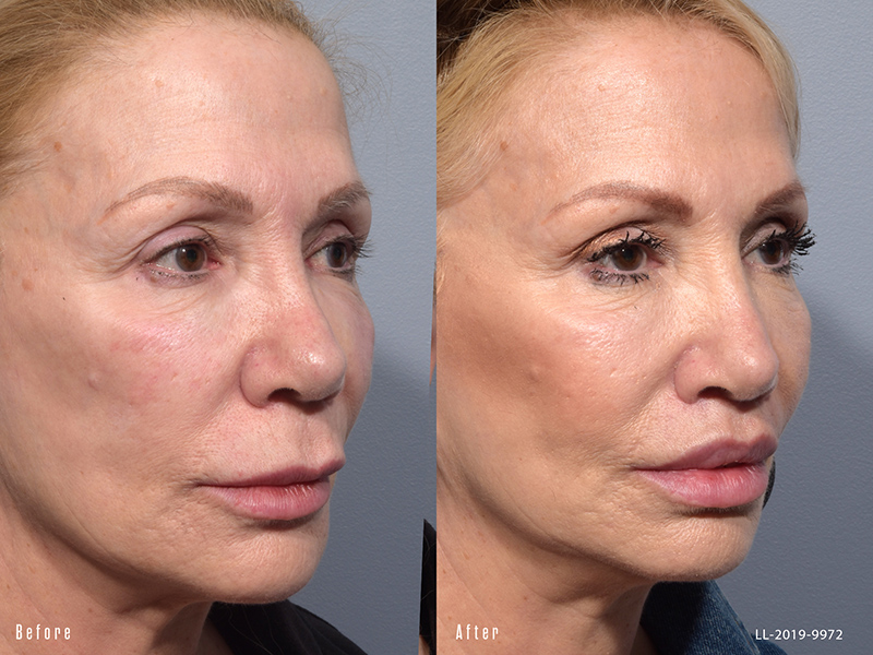 Female showing before and after results from a surgical lip lift