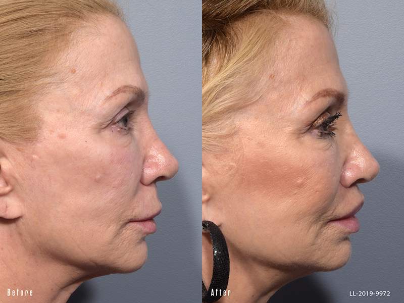 Female showing before and after results from a surgical lip lift