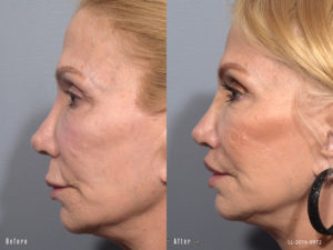 Female showing before and after results from a surgical lip lift