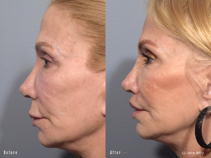 Female showing before and after results from a surgical lip lift
