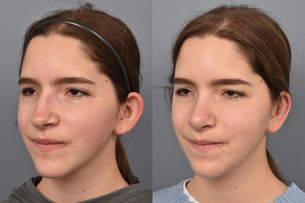 Photo of teenage female before and after rhinoplasty