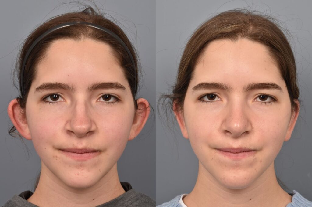 Photo of teenage female before and after rhinoplasty