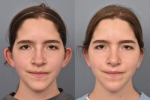 Photo of teenage female before and after rhinoplasty