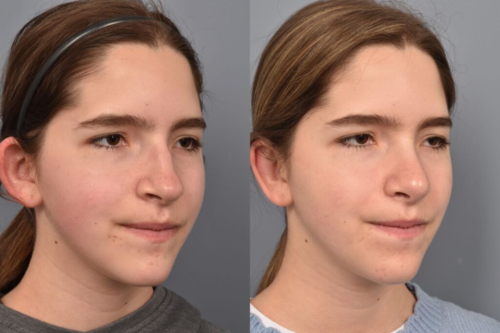 Photo of teenage female before and after rhinoplasty