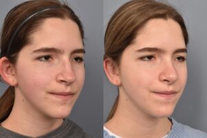 Photo of teenage female before and after rhinoplasty